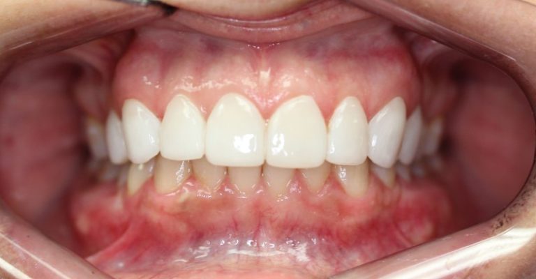 Teeth After LUMINEERS
